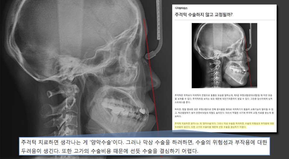 주걱턱 치료하면 생각나는 게 '양악수술'이다. 그러나 막상 수술을 하려하면, 수술의 위험성과 부작용에 대한 두려움이 생긴다. 또한 고가의 수술비용 때문에 선뜻 수술을 결심하기 어렵다.