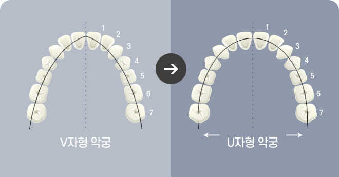 V자형 약궁 → U자형 약궁