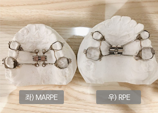 좌) MARPE / 우) RPE