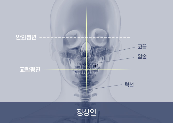 정상인 엑스레이 사진