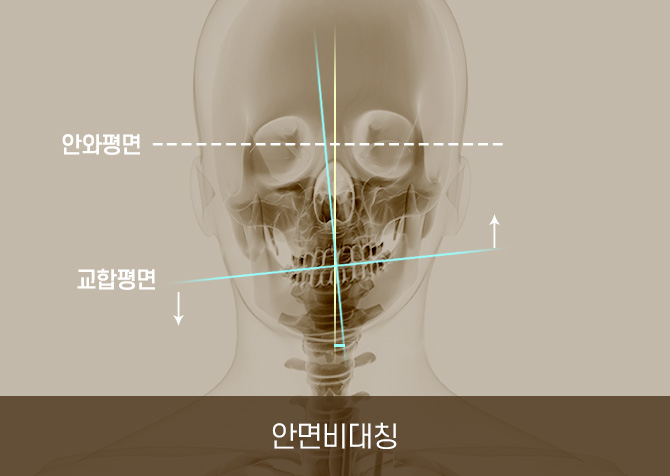 안면비대칭 엑스레이 사진