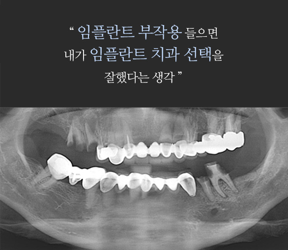 “ 임플란트 부작용 들으면 내가 임플란트 치과 선택을 잘했다는 생각 ”