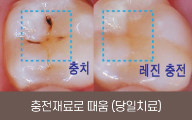 충전재료로 때움 (당일 치료)