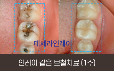 인레이 같은 보철치료 (1주)