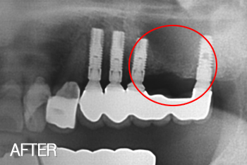 뼈 복원이 미흡한 상태에서 무리하게 짧은 임플란트 식립.결국 임플란트 제거 치료 후