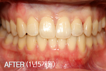 3급 부정교합 교정(주걱턱/반대교합 치아교정)투명교정으로 해결한 사례 치료 후