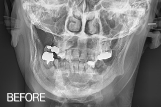 턱통증& 안면비대칭 비수술 골격교정/턱교정과 임플란트 치료 병행 치료 전