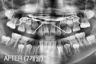 비대칭/덧니/악궁확장 치료 치료 후