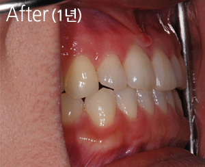  투명교정 전후 사진 [CASE:부정교합>반대교합] 치료 후