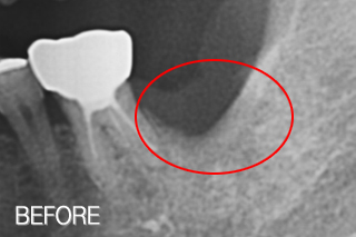 자가치아뼈이식 임플란트 치료사례 (아래 어금니 발치 후 자가치아뼈이식 가공) 치료 전