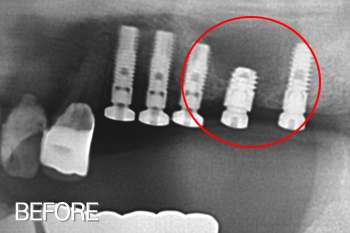 뼈 복원이 미흡한 상태에서 무리하게 짧은 임플란트 식립.결국 임플란트 제거 치료 전