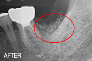자가치아뼈이식 임플란트 치료사례 (아래 어금니 발치 후 자가치아뼈이식 가공) 치료 후