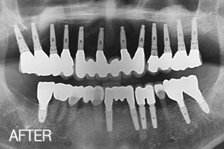 전체임플란트 전후,미소드림치과 임플란트치료사례 (전체임플란트 10년이상 사용 中) 치료 후