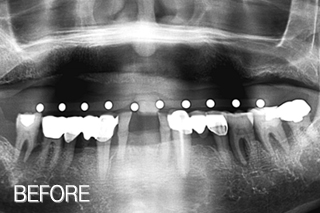 전체임플란트 전후,미소드림치과 임플란트치료사례 (전체임플란트 10년이상 사용 中) 치료 전