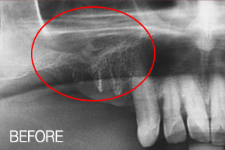 상악동거상술 뼈이식 임플란트 증례 (윗 어금니 임플란트뼈이식>상악동거상술) 치료 전