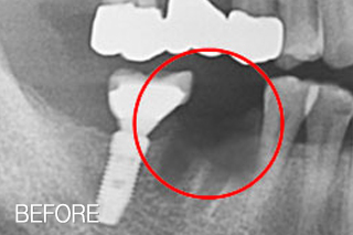 자가치아뼈이식 임플란트 치료사례 - 아래 어금니임플란트, 뼈이식 병행-자가치아뼈이식 치료 전