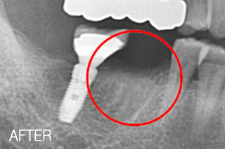 자가치아뼈이식 임플란트 치료사례 - 아래 어금니임플란트, 뼈이식 병행-자가치아뼈이식 치료 후