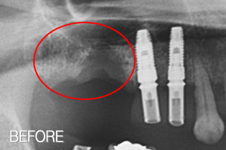 자가치아뼈이식 임플란트 치료사례 (큰 어금니 발치 후 자가치아뼈이식재로 가공) 치료 전