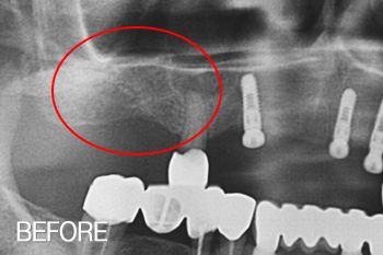 뼈이식 재수술 + 임플란트 재수술 [ 미소드림치과/윗어금니 뼈이식 임플란트 사례] 치료 전