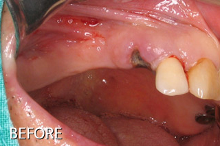 윗 어금니임플란트 치료 전후, 어금니임플란트수술 후기 미소드림치과 치료 전