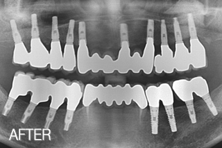 상악 전체임플란트, 하악 어금니임플란트로 치아건강 회복 치료 후