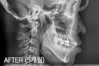 턱비대칭 교정 치료 치료 후