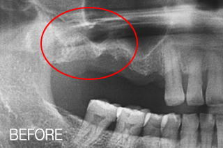 자가치아뼈이식 임플란트 - 어금니 발치 후 임플란트/뽑은 어금니를 자가치아뼈이식재로 가공처리 치료 전