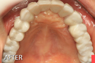 윗니 무치악임플란트(고정식 임플란트틀니)와 아랫니는 어금니 임플란트 치료 후
