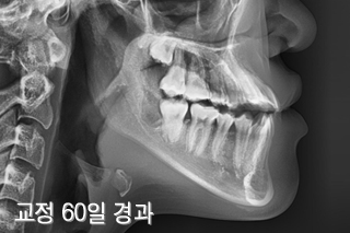 비수술주걱턱교정 (2개월 경과) 치료 후