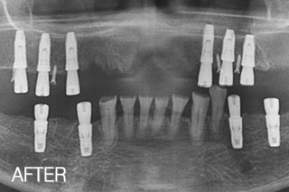 무치악임플란트 전후 [하이브리드/임플란트틀니/고정식] 전체임플란트 치료사례 치료 후