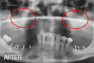 윗니, 상악동거상술 뼈이식이 병행된 어금니임플란트/ 아랫니 뼈이식임플란트가 병행된 어금니임플란트 치료 후