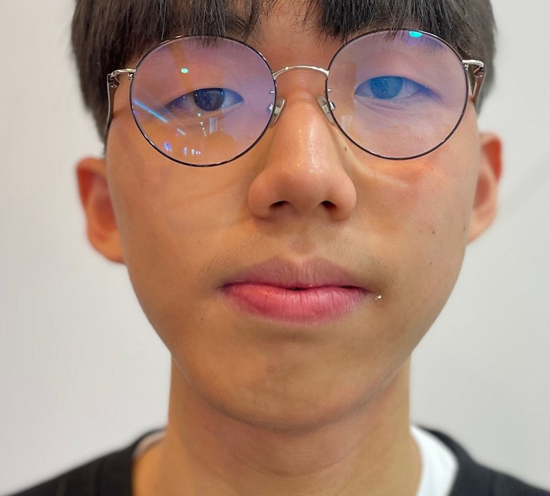 청소년 안면비대칭 교정 마무리 정면 사진, 2023년 8월 촬영