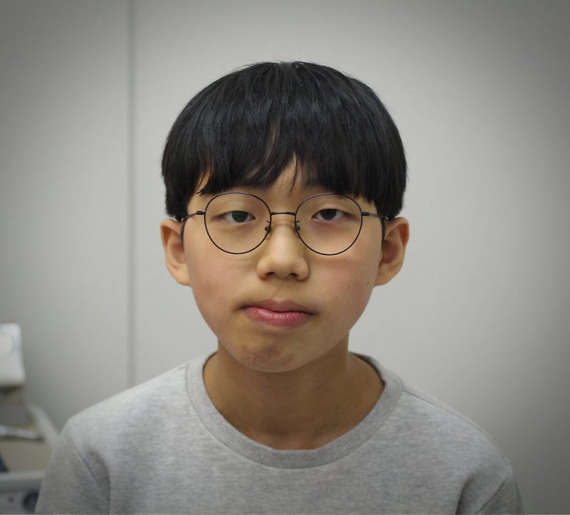 청소년 안면비대칭 교정 중 정면 사진, 2020년 촬영