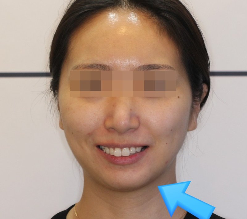 무턱 교정 후 정면 사진, 2022년 4월 촬영