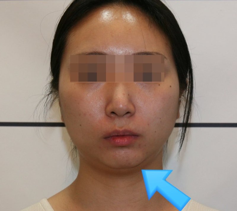 무턱 교정 전 정면 사진, 2020년 9월 촬영