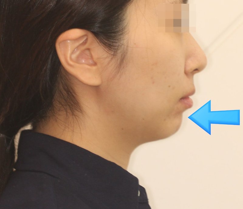 무턱 교정 후 옆모습, 2022년 4월 촬영