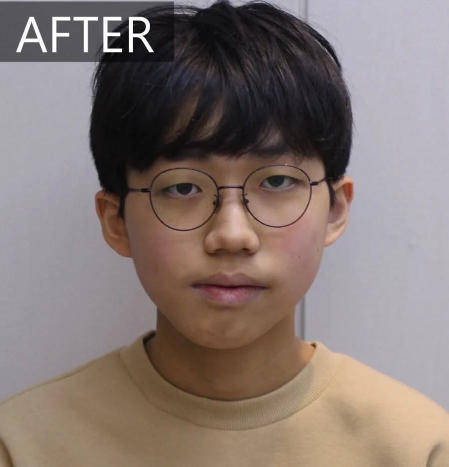 안면윤곽수술 대신, 15세의 턱 비대칭 교정 치료 후