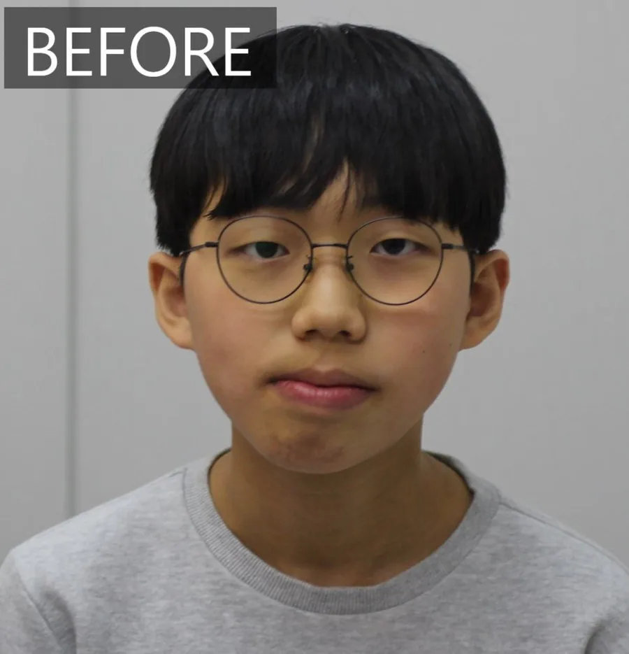 안면윤곽수술 대신, 15세의 턱 비대칭 교정 치료 전
