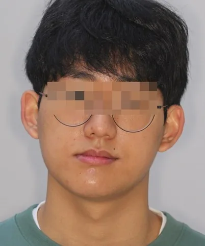 양악수술 대신 선택한 비수술 교정 치료 전