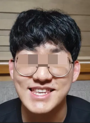 교정기 착용 모습