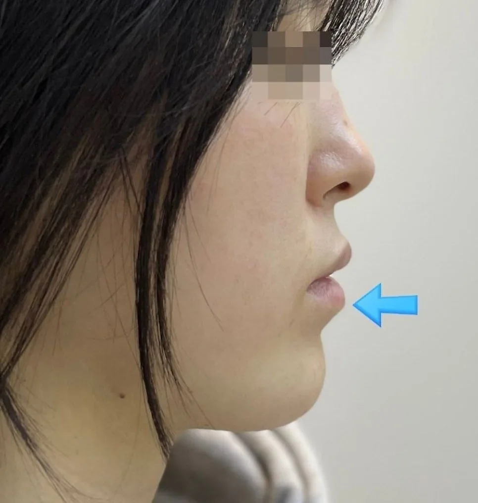 반대교합 교정 후 옆모습 — 아래턱이 들어간 모습, 치료 후 촬영