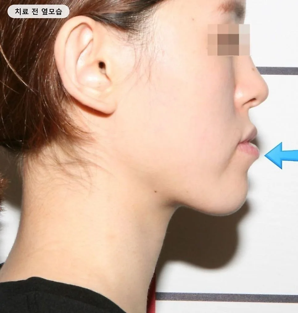 반대교합 교정 전 옆모습 — 아래턱이 앞으로 나온 모습, 치료 전 촬영
