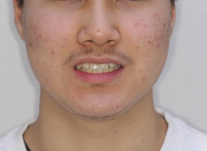 이를 뽑지 않고 고른 덧니, 3년의 기록 치료 후