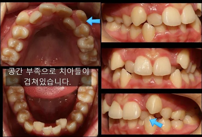 교정 전 치아 — 공간 부족으로 겹침, 2019.02 촬영
