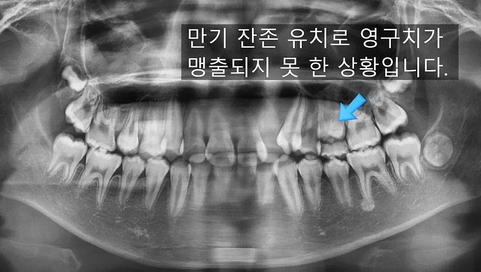 초진 파노라마 — 만기 잔존 유치로 영구치가 나오지 못한 상태