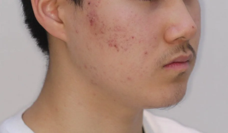 교정 후 측면 — 입이 나오지 않음