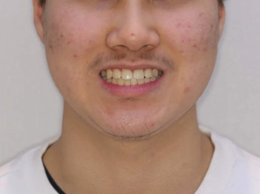 교정 후 웃는 모습, 2021 촬영