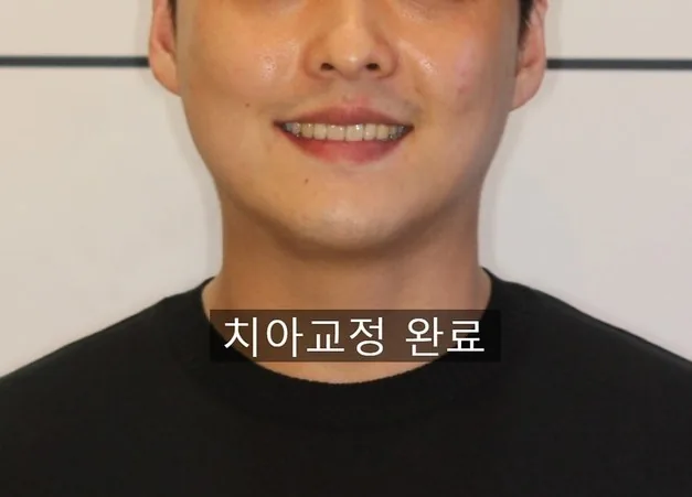 작은 위턱과 빠진 어금니, 4년의 교정 치료 후