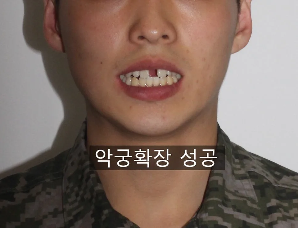 악궁확장을 마친 때의 모습