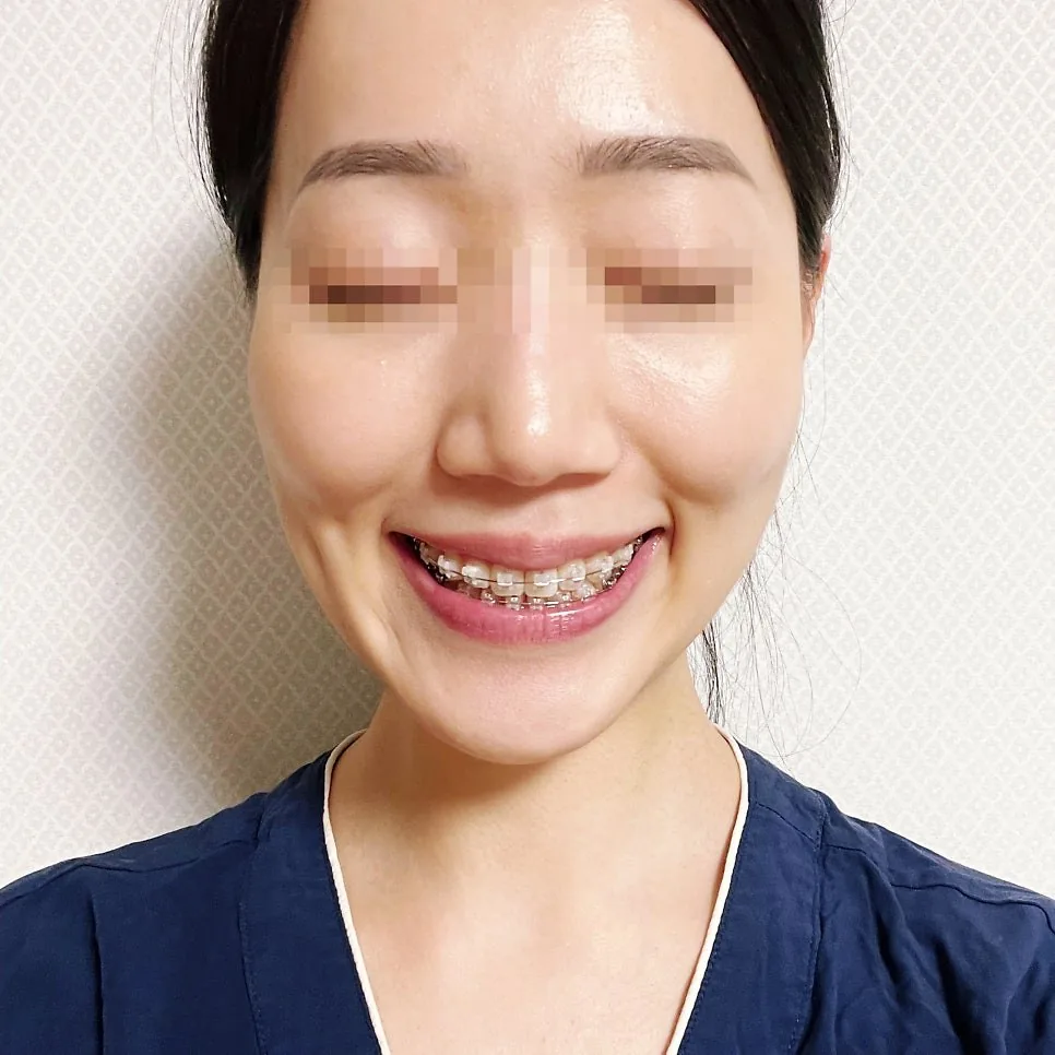 악궁확장 후 측면 모습 (2024.01)